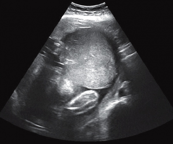 Матка Кувелера