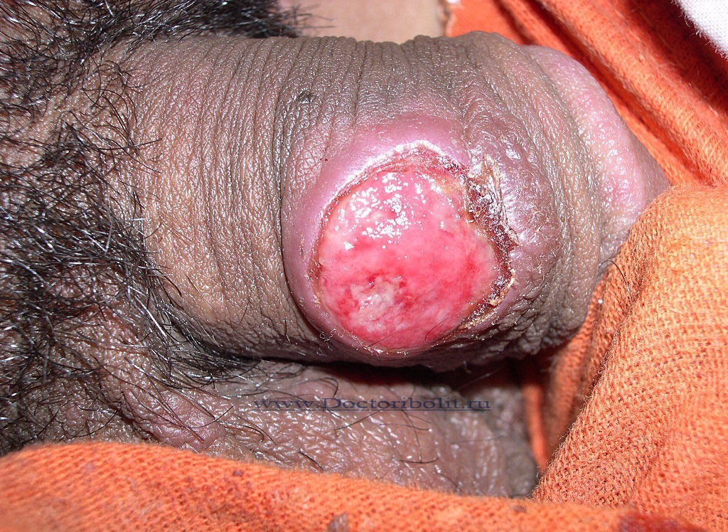 Твердый шанкр на половом члене